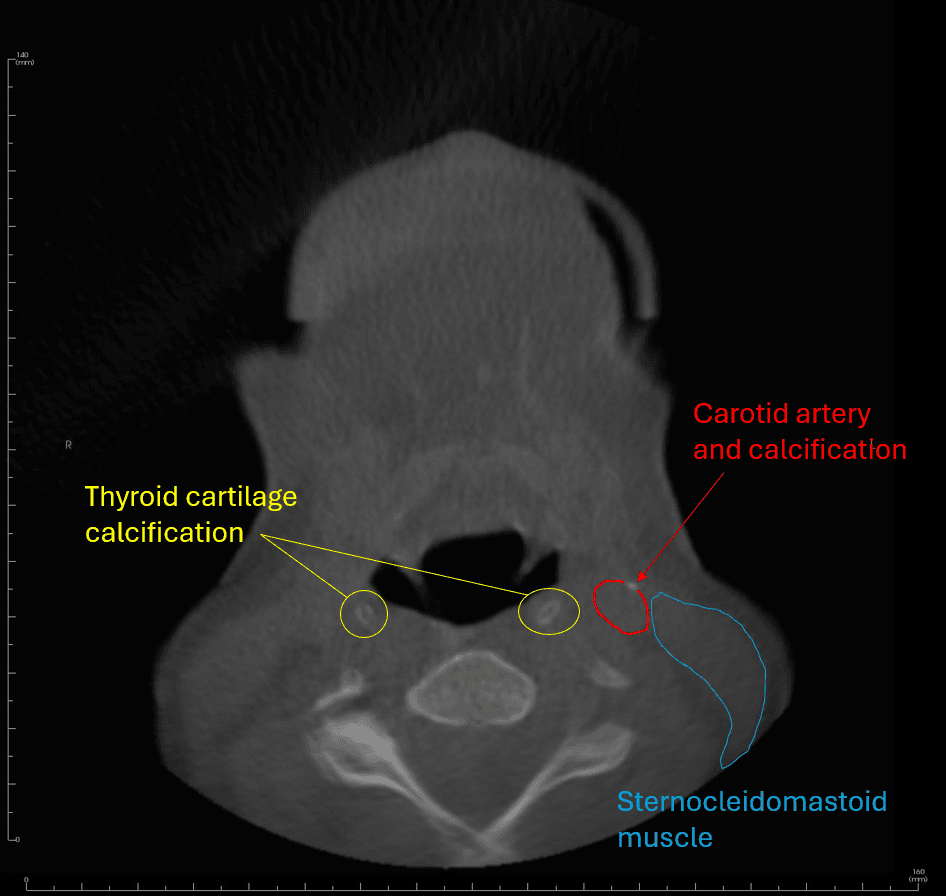 Axial slice
displaying carotid artery calcification.